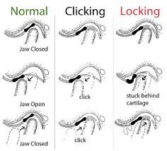 TMJ clicklocknormal